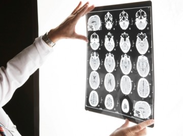 Acute Ischemic Stroke: Thombolysis is an Effective Therapy