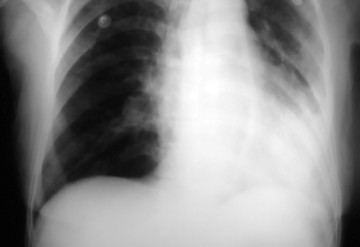 Community acquired pneumonia