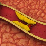 What’s new in dyslipidemia