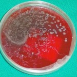Never ignore an elevated eosinophil count – especially in travellers, immigrants and refugees