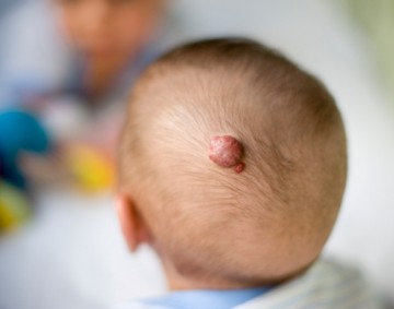 Paradigm shift in treatment of hemangiomas