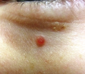 Pyogenic granuloma